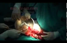 Operacja usunięcia glist z jelita pacjenta