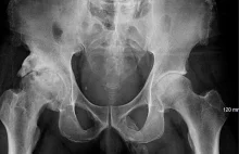 Członek, który zamienia się w kość. Tak, naukowy są pewni.