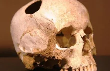 Prehistoryczna amputacja. Neolityczna amputacja z Buthiers-Boulancourt