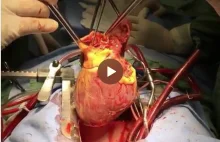 Wyciągnięcie starego serca podczas przeszczepu