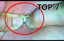 TOP 7 on this Week ! Fresh Video! - ZITs | PIMPLEs | Blackheads |...