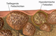 Skąd się bierze cellulit? Lipodystrofia - przyczyny | You control your body