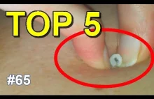 PIMPLES & ZITS - TOP 5 Video Of The Week ! - All pimples channel