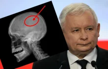 Komplikacje podczas operacji Jarosława Kaczyńskiego. Lekarze musieli też...