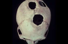 Trepanacja czaszek w prekolumbijskim Peru