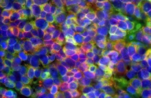 Wspólny mechanizm podstawą rozwoju agresywnych nowotworów drobnokomórkowych