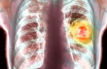Rak płuca - wzrost zachorowań wśród kobiet.