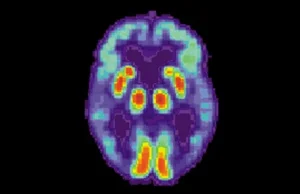 Sztuczna inteligencja pozwala na wcześniejsze diagnozowanie choroby Alzheimera