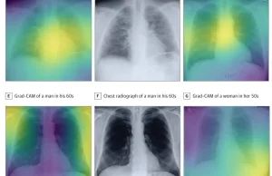 AI przewiduje ryzyko śmierci na podstawie 1 rentgena