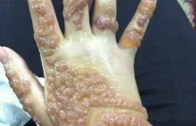 Reakcja alergiczna na hennę