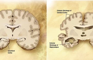 Porównanie mózgu osoby zdrowej i chorej na chorobę Alzheimera