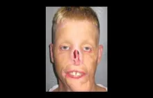 Mitch Hunter: Pełna procedura przeszczepu twarzy