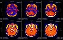 Bug w oprogramowaniu do fMRI może mieć wpływ na wyniki około 40 000 publikacji.
