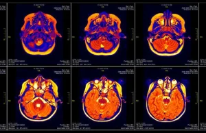 Bug w oprogramowaniu do fMRI może mieć wpływ na wyniki około 40 000 publikacji.