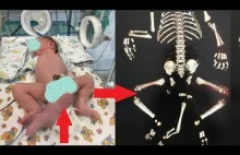 Dziecko urodzone z trzema nogami, dwoma penisami i bez odbytu