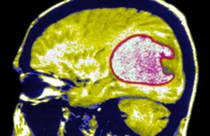 Wzrasta liczba złośliwych guzów mózgu. Czy to przez telefony komórkowe?