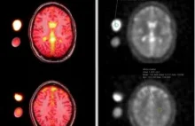 Badanie: tropy migreny prowadzą do poziomu sodu w płynie mózgowo-rdzeniowym