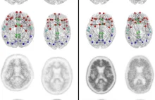 Radiologiczna diagnoza Alzheimera