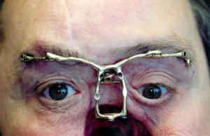Mężczyzna żyje od 10 lat z dziurą w twarzy