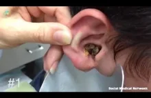 Usuwanie woskowiny z ucha