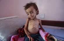Jemen: już 85 000 dzieci w wieku poniżej 5 lat umarło z głodu