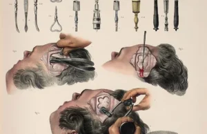 Procedury chirurgiczne w 1800 roku