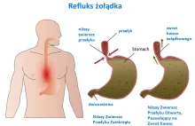 Masz ciągle zgagę? Źle się czujesz po posiłku / alkoholu? To choroba refluksowa!