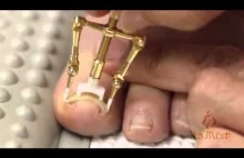 Japońska metoda prostowania wrastającego paznokcia