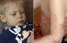 2-letni chłopiec poparzył się wrzątkiem, potrzebuje rehabilitacji
