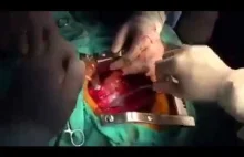 Operacja na otwartym sercu podczas trzęsienia ziemi w meksyku