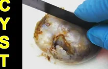What’s Inside a Cyst ?