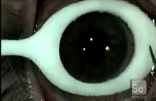 Jak wygląda laserowa korekcja wzroku?