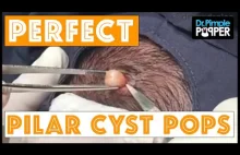 Pilar Cysts Come in All Shapes & Sizes: a FBF Compilation
