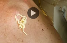 The Longest of CYST on Back