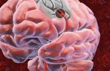 Cerebrovascular disease