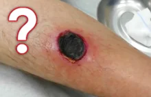 SCAB, BLACKHEAD or PORE OF WINER! WHAT IS IT ?
