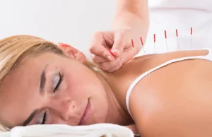 Akupunktura — cudowna terapia igłami