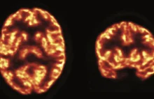Dzięki nowej metodzie obrazowania jeszcze lepiej poznamy schorzenia mózgu