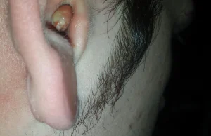 Niesamowita infekcja ucha jednego z użytkowników reddita