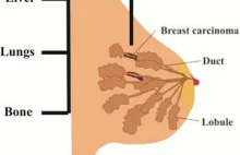 Nowa immunoterapia usunęła wszystkie guzy u kobiety z przerzutowym rakiem piersi