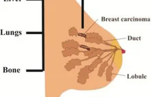 Nowa immunoterapia usunęła wszystkie guzy u kobiety z przerzutowym rakiem p----i