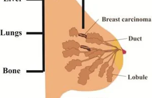 Nowa immunoterapia usunęła wszystkie guzy u kobiety z przerzutowym rakiem piersi