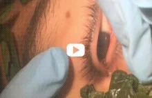 Okulista w Peru z sukcesem wyjmuje 3 cm robaka z oka pacjenta [film]
