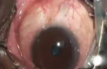 Lekarze usunęli 19 centymetrowego nicienia z oka pacjenta VIDEO [ENG]