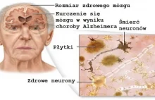 Choroba Alzheimera – jak jej zapobiegać? - Krok do Zdrowia