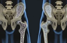 Jak naturalnie leczyć osteoporozę