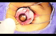 Enukleacja oka - czyli usunięcie gałki ocznej