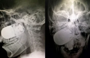 Kolumbia: Lekarze wyciągneli granat z twarzy żołnierza.