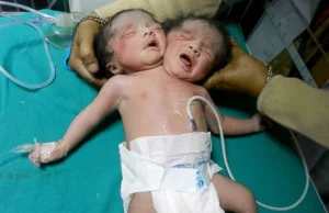 Dziecko z dwiema głowami narodziło się w Indiach !