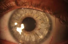 Tak wyglądają szwy na oku po przeszczepie rogówki.